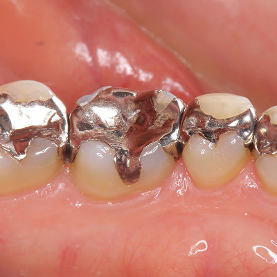 銀歯(保険適用)