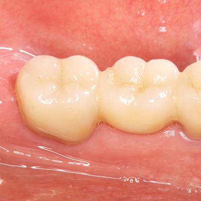 セラミック(自費治療)