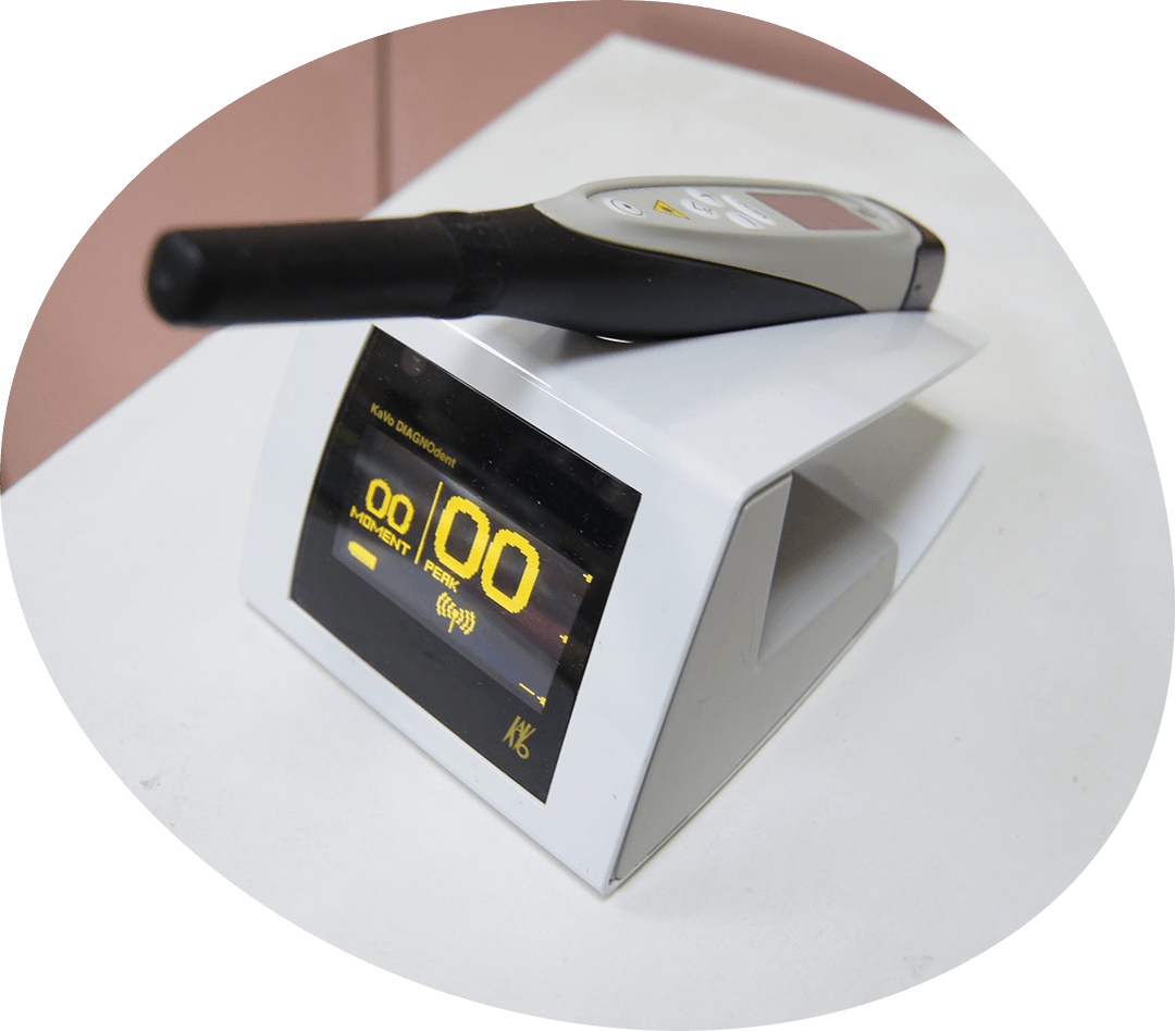 虫歯の進行を正確に把握