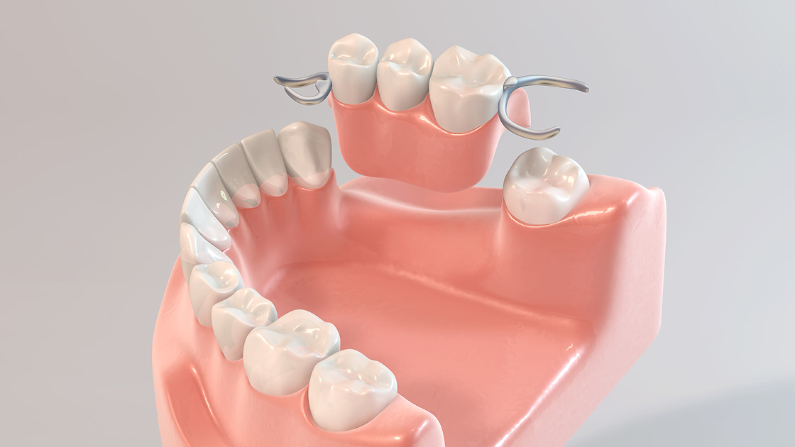 部分入れ歯（部分床義歯）