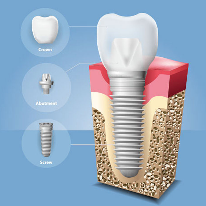 インプラントとは