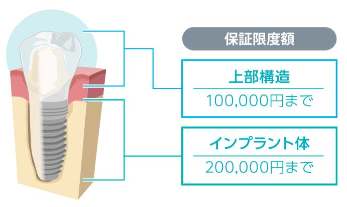 【保証限度額】上部構造:100,000円まで、インプラント体:200,000円まで
