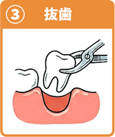 ③抜歯