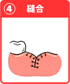 ④縫合