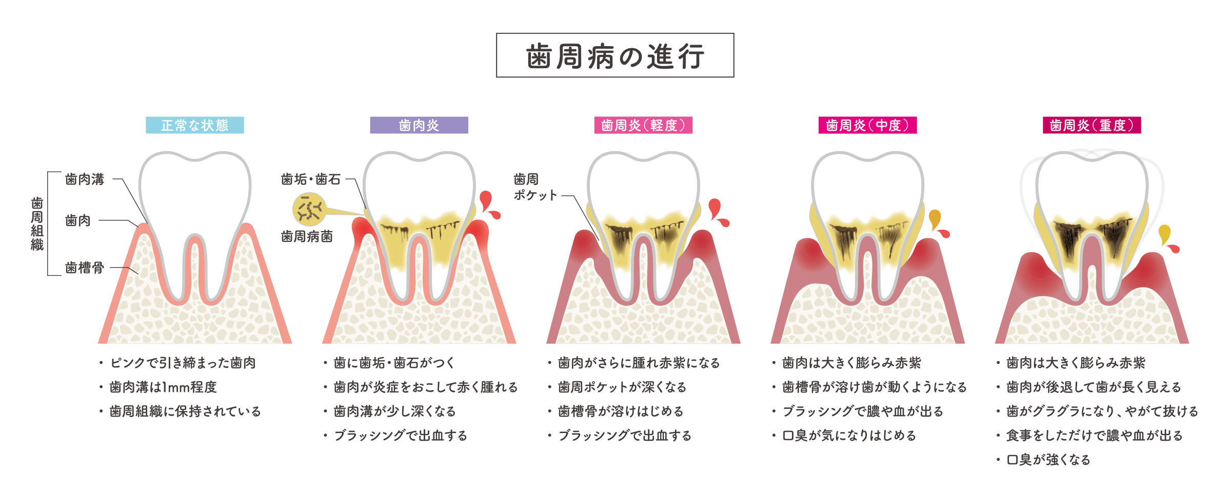 歯周病の進行段階