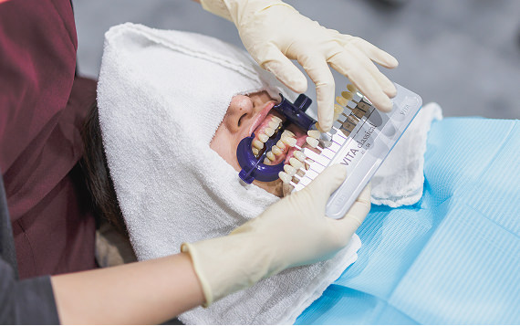 治療前の歯の色チェック