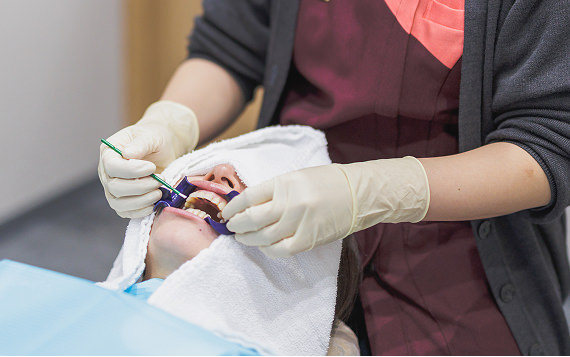 ホワイトニング剤の塗布